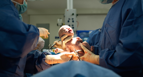 Once a C-section ask dr angela