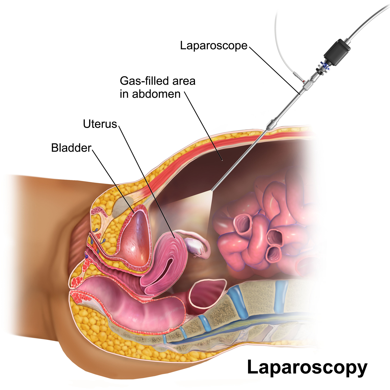 dr-angela-endometriosis-diagnostic-laparoscopy