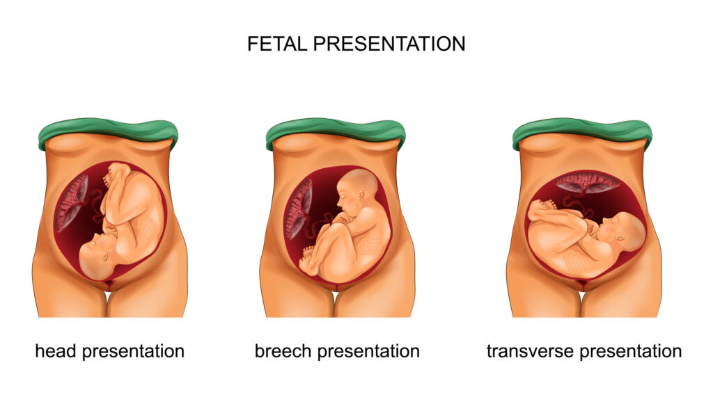 dr-angela-breech-position-fetal-presentation