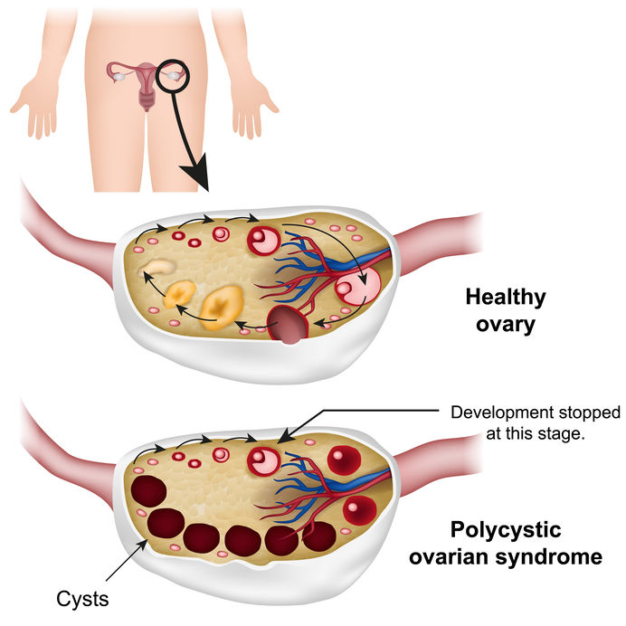 polycystic ovary syndrome (PCOS))