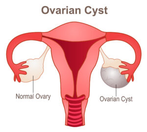 dr-angela-normal-ovary-ovarian-cysts
