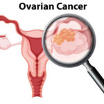 Ovarian Cancer: Symptoms, Causes and Treatment