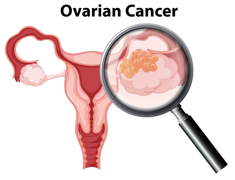 ovarian-cancer-symptoms-causes-treatment